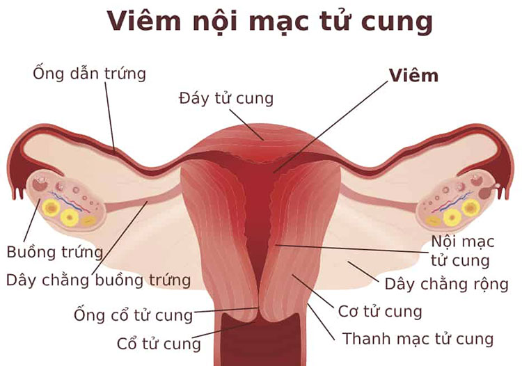 Coi chừng đau bụng kinh nhưng ra máu ít (kinh nguyệt ít)? 1 Coi chừng đau bụng kinh nhưng ra máu ít (kinh nguyệt ít)? 1