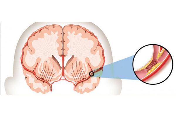 Tai biến mạch máu não là hiện tượng máu lưu thông đến não đột nhiên bị chặn lại (Ảnh minh họa)